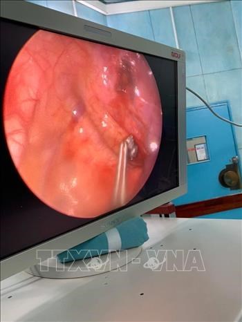 Các bác sĩ Bệnh viện Nhi đồng 2 Thành phố Hồ Chí Minh gắp viên đạn ra khỏi lồng ngực bệnh nhi bằng phương pháp phẫu thuật nội soi. Ảnh: TTXVN