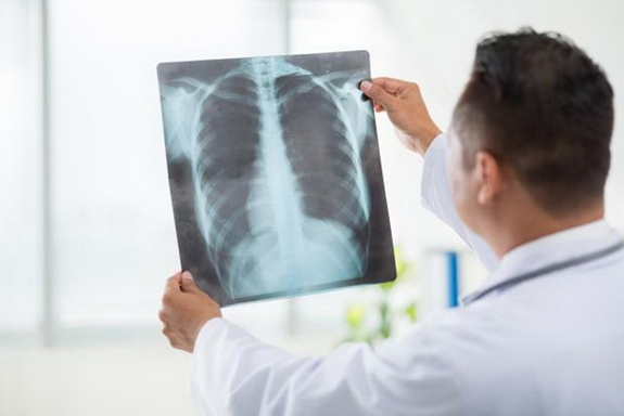 Thiết bị SpiroNose hứa hẹn sẽ giúp điều trị hiệu quả bệnh ung thư phổi.